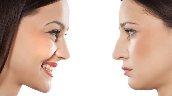 rhinoplasty